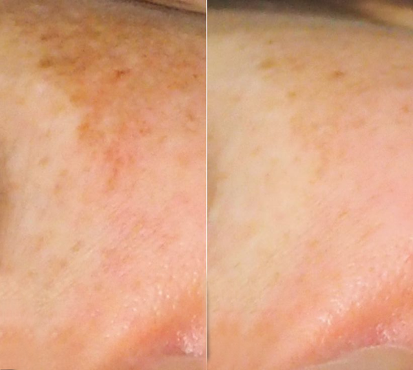 Anti tache, dépigmentant