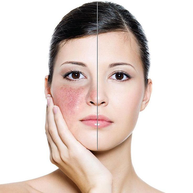 Peaux sensibles et rougeurs